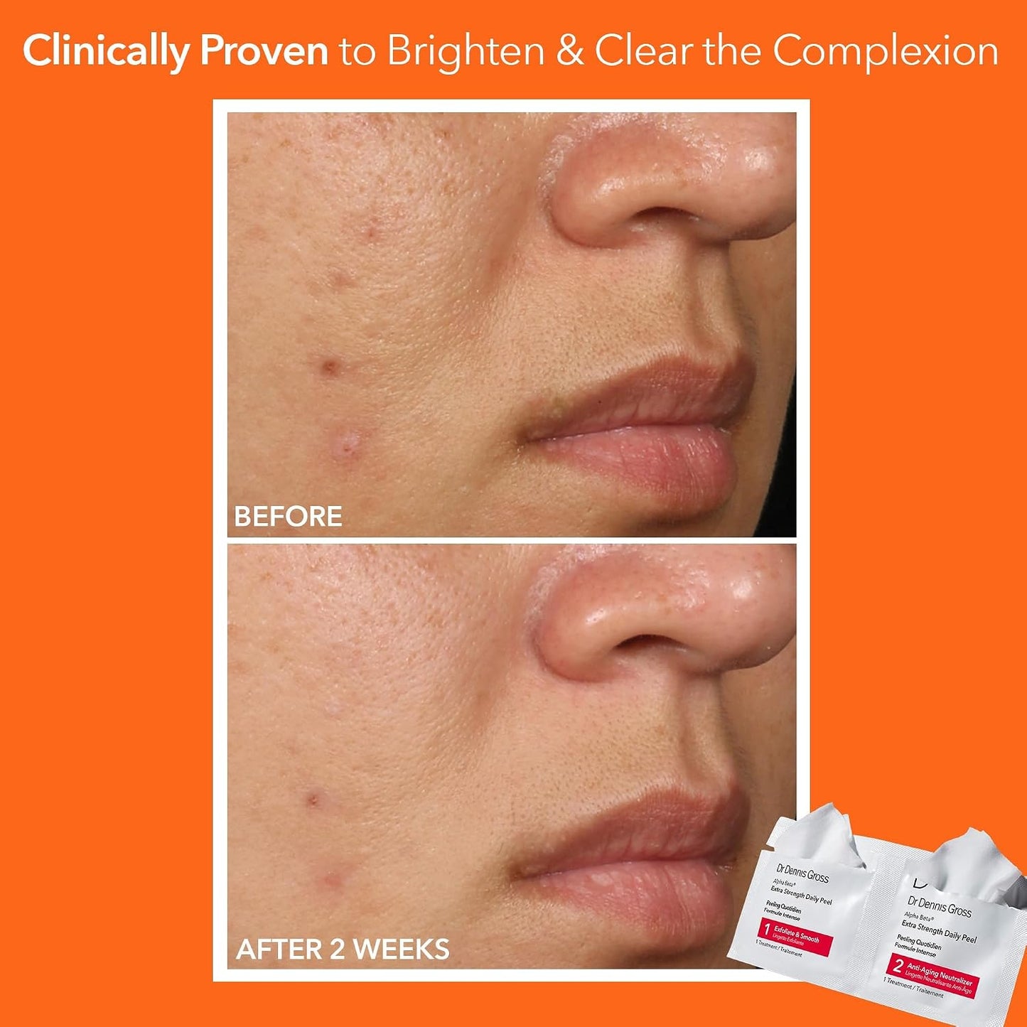 Dr. Dennis Gross Alpha Beta Daily Peel - 2-Step Exfoliating Pads for Smoother Skin & Radiance, 5 Treatments